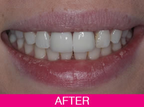 smile makeover after treatment